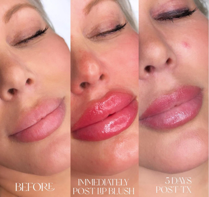 Заполнители губ 2ml Skinject глубокие Hyaluronic кисловочные дермальные вводимые