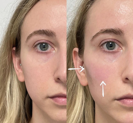 Заполнители губ 2ml Skinject глубокие Hyaluronic кисловочные дермальные вводимые