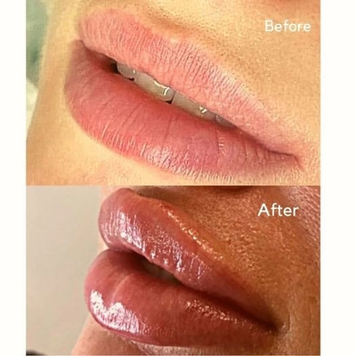 Вводимая впрыска Juvederms заполнителя заполнитель ультра 3 HA дермальный для тома губы