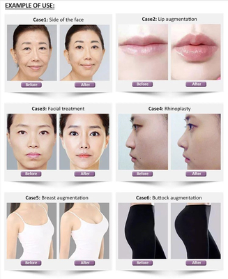 Крест точной глубокой подводной лодки-Q Revolax Hyaluronic кисловочный соединил дермальный заполнитель 1.1ml