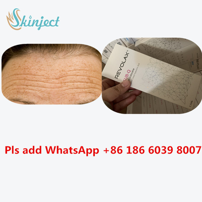 Hyaluronic кисловочный дермальный заполнитель 1ml Revolax глубокий для впрыски губ