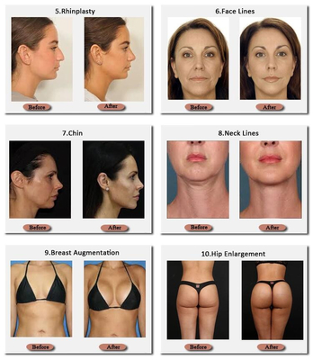 Skinjection заполнитель корейское Technnology груди 10 Ml и 20 Ml Hyaluronic 24 Mg/Ml