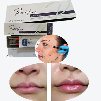 Dermal Filler Lip Injections Facial Fillers Juvederm Ultra 3 Ultra 4 Voluma