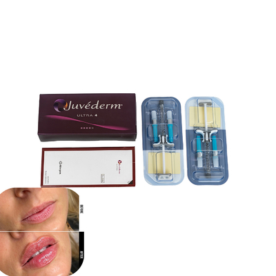 Juvederm Dermal Filler для губ Инъекционные наполнители гиалуроновой кислоты
