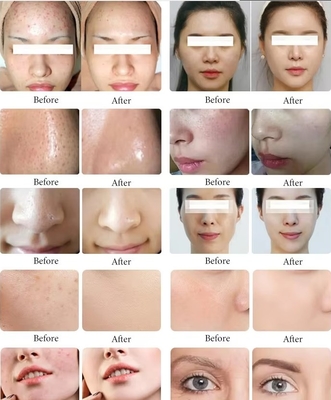 Новый продукт Black Pearl 10 в 1 Hydra Peel Machine Микродермабразионная машина Фейс-Спа Микротач Hydra Skin Care