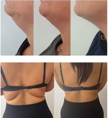 Лимон Бутылка Инъекции растворяющие жир Липолитический раствор