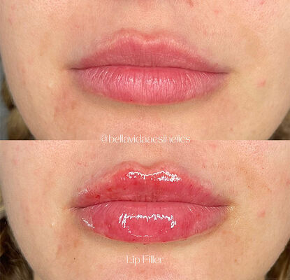 Срок годности 2 года гель для инъекций с кожным наполнителем, предназначенный для уменьшения морщин, контура лица и оживления кожи