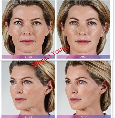 Заполнители геля Juvederm Voluma 2x1ml Hyaluronic кисловочные вводимые