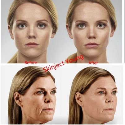 Заполнители геля Juvederm Voluma 2x1ml Hyaluronic кисловочные вводимые