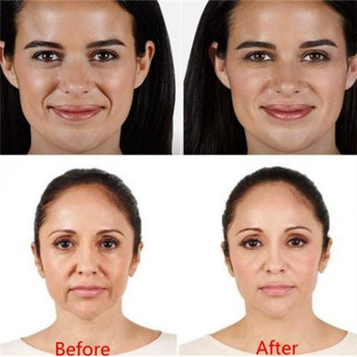 Заполнитель ручки Juvaderm Voluma Hyaluronic кисловочный для морщинок глаз лба