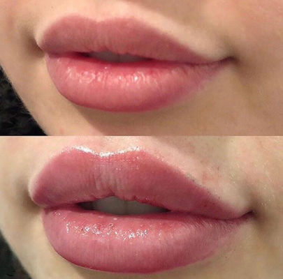 Русские губы Juvederm ультра 3 с заполнителем  соединенным крестом дермальным