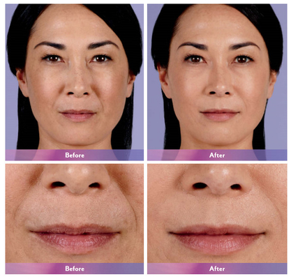 Впрыска ультра 4 губы заполнителя Juvederm дермальная для увеличения губы