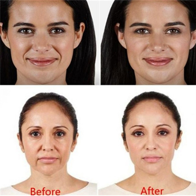 Медицинский заполнитель губы Derma заполнителя Juvederm Voluma геля Hyaluronate натрия