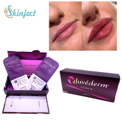 Nasolabial заполнитель Hyaluronic кисловочное Juvederm Ultra3 губ 2x1ml створок дермальный