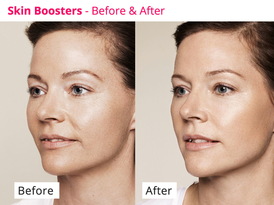 Кожа Rejuvenating сыворотка PDRN Skinbooster Meso для регенерации коллагена