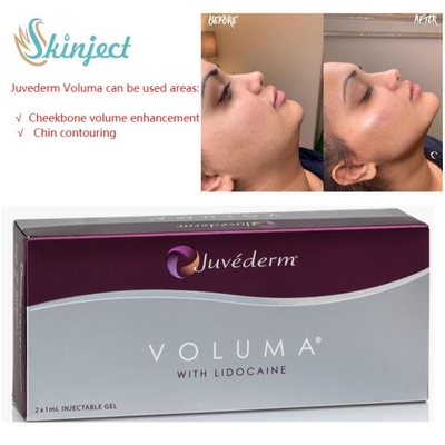 Заполнители Juvederm Voluma 2x1ml Hyaluronic кисловочные дермальные для скулы