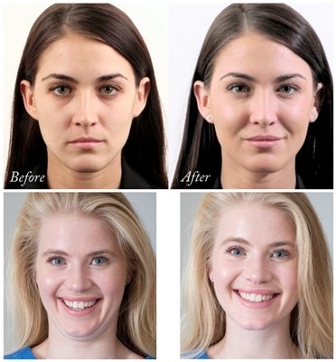 Заполнитель Juvederms Voluma Hyaluronic кисловочный лицевой для увеличения Chin и щеки