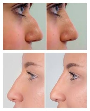 Заполнитель Juvederms Voluma Hyaluronic кисловочный лицевой для увеличения Chin и щеки