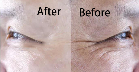 Hyaluronic кисловочный забеливать регенерации коллагена заполнителя и анти- старея впрыска