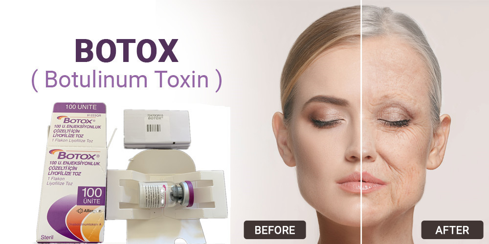 тип токсина 100Units Allergan Botulinum впрыска для лицевого удаления морщинки