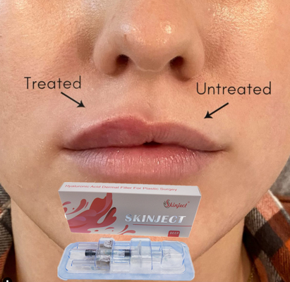 Вводимая глубокая Hyaluronic кисловочная створка Chin дермальной щеки заполнителя губы 2ml Nasolabial